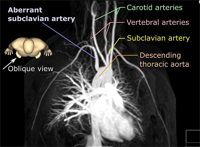 Subclavian Artery The Definitive Guide Biology Dictionary