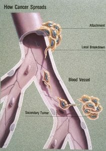 Metastasis illustration