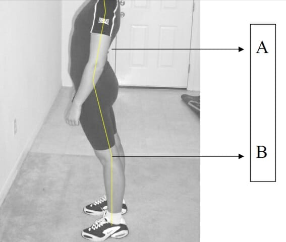 Lordosis