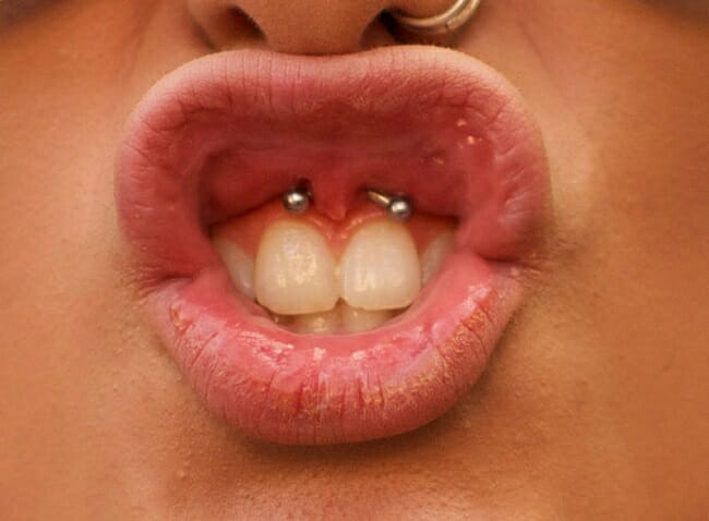 Frenulum Frenulum