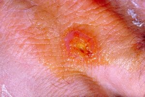 Tularemia lesion