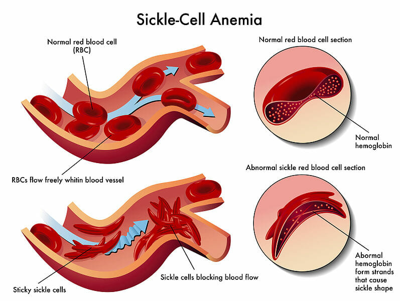 sickle cell anemia mutation