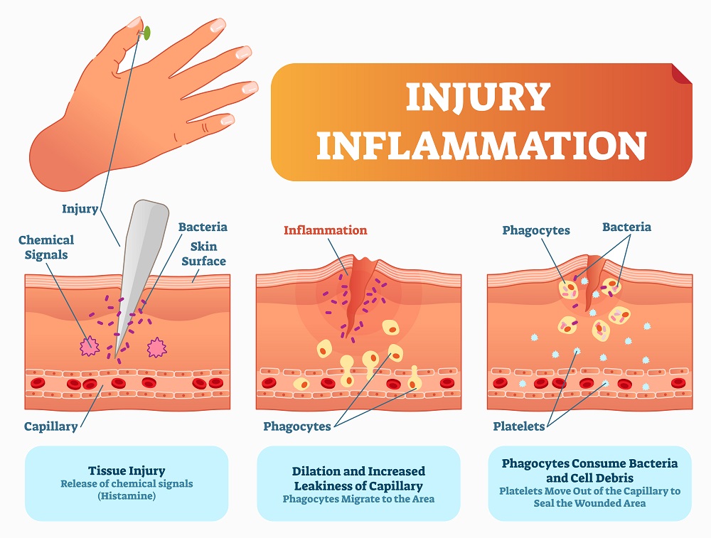 Inflammation Response Diagram