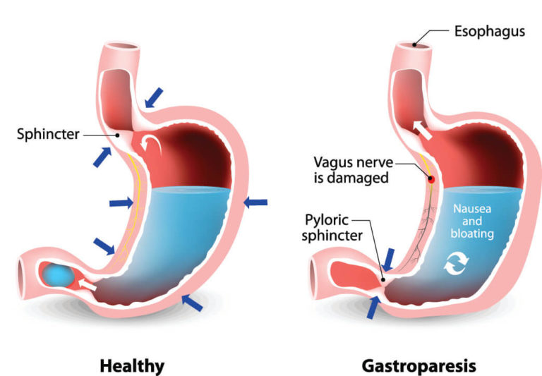 gastroparesis-symptoms-causes-and-natural-support-strategies