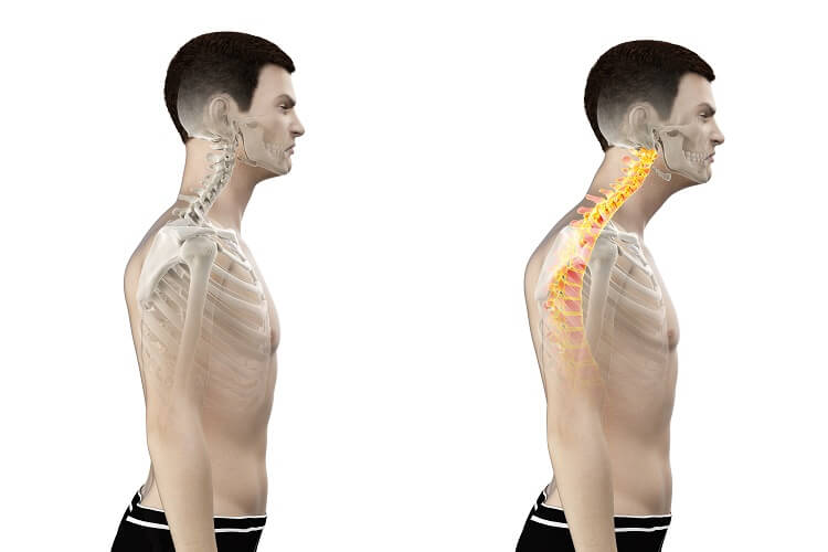 https://biologydictionary.net/wp-content/uploads/2020/05/head_forward_posture.jpg