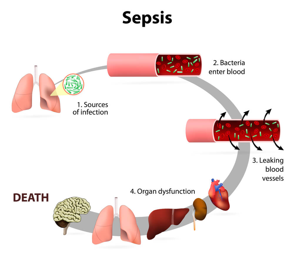 Staphylococcus aureus Infections