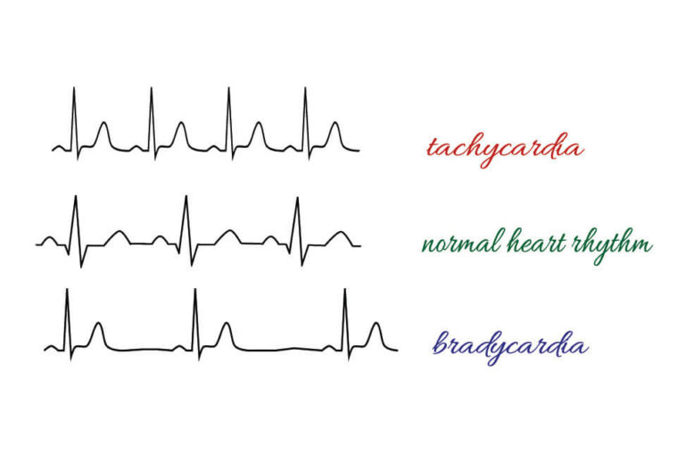 Junctional Rhythm - The Definitive Guide | Biology Dictionary