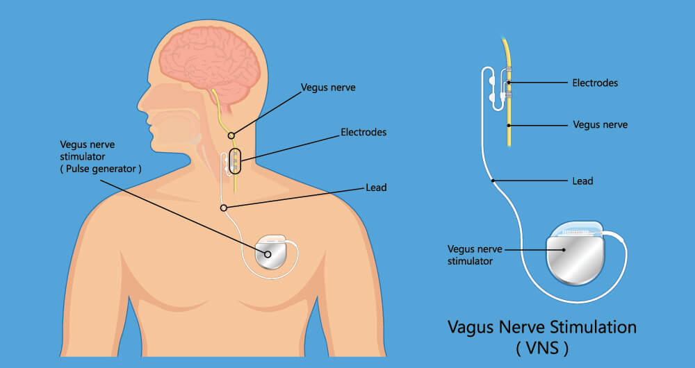 vagus-nerve-stimulation-ocean-shores-urgent-care