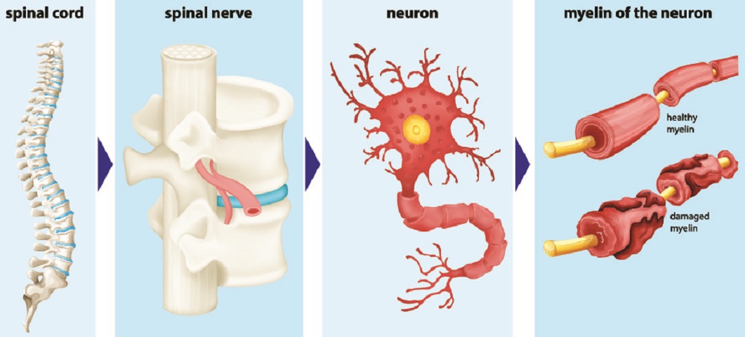 multiple sclerosis MS myelin demyelination disease