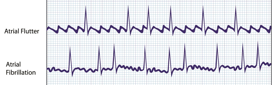 afib flutter