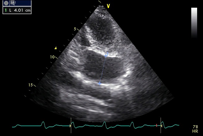 dilated coronary sinus ultrasound transoesophageal