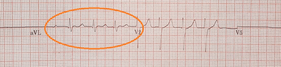 ecg-t-wave-changes-and-interpretation