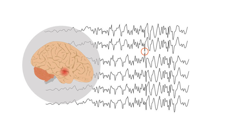 transient epileptic amnesia generalized seizure