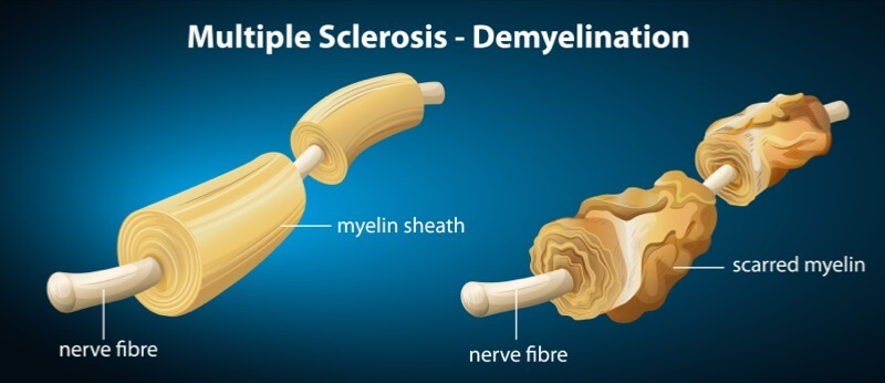 graphic of multiple sclerosis
