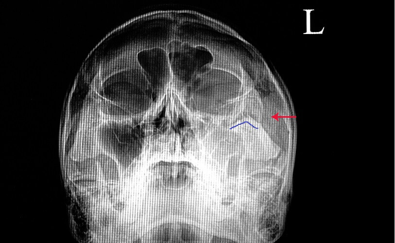 zygomatic arch x ray positioning