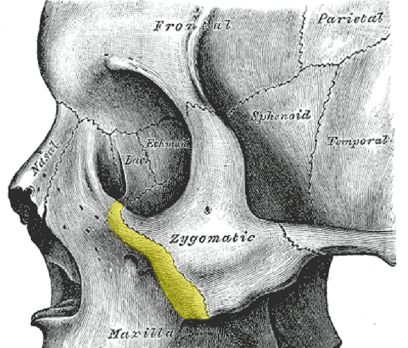 zygomatic arch fracture symptoms