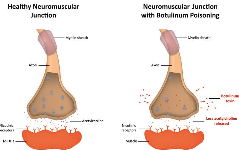 botulinum toxin nikotin patkány)