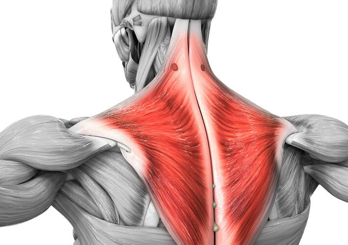 trapezius tear signs symptoms