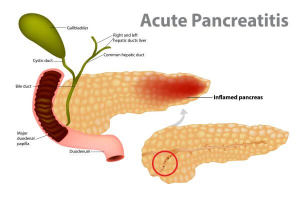Acute Pancreatitis Pathway